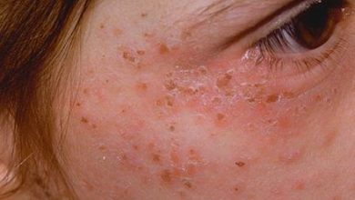 Porphyria